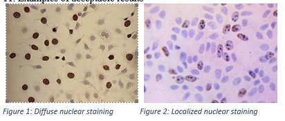 Figure 5. MCF-7 cells stained for BrdU incorparation using the X1545K.1 kit. Note the exclusive nuclear immunostaining with a diffuse staining pattern (Fig. 1) and a more localized pattern (Fig. 2).
